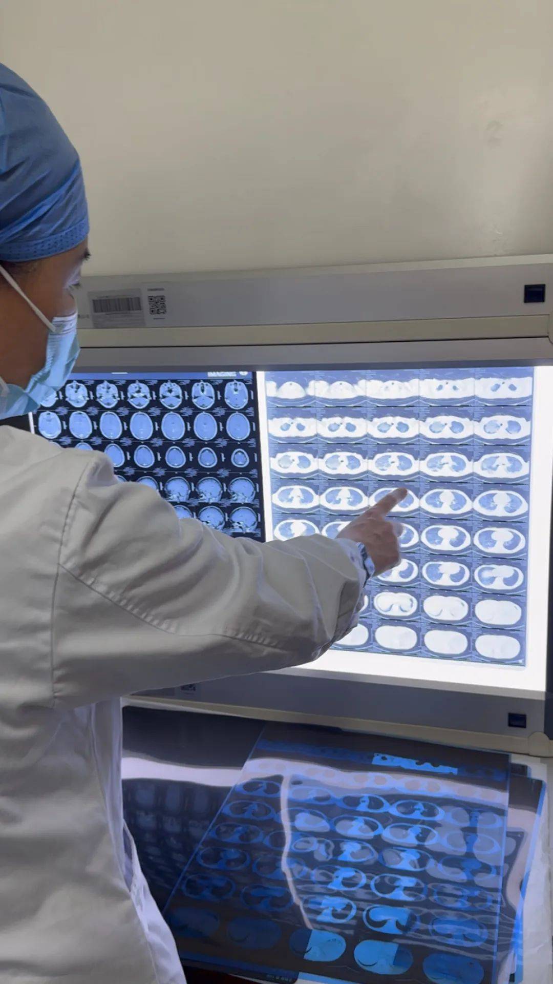 皇冠信用网开户_河南一大学生咳嗽发烧近一月皇冠信用网开户，多家诊所误当感冒治，医生：肺已全白