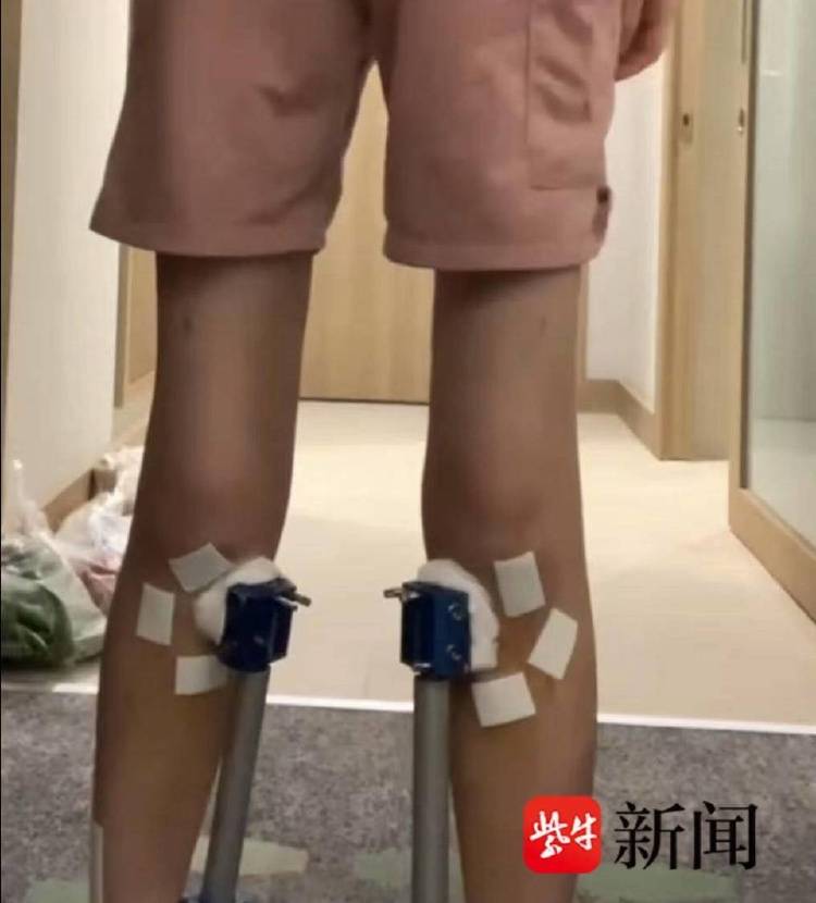 非洲足球冠军联赛_女子去国外“断骨增高”非洲足球冠军联赛，后遗症缠身维权难：像有定时炸弹藏在身体里