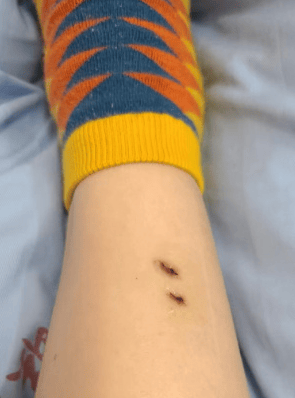 新2網址_女子在云南被银环蛇咬伤打了十多支血清新2網址,自称2年后仍有后遗症:头晕脸麻,没想到恢复得这么慢