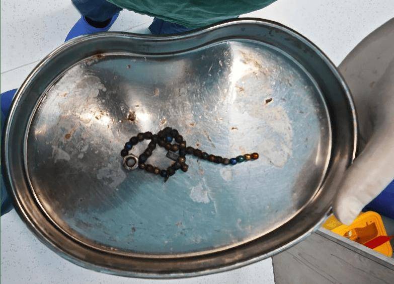 拜仁慕尼黑足球_整整37颗拜仁慕尼黑足球！云南4岁孩子身体里取出……医生紧急提醒！