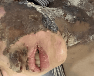 皇冠注册平台_温州一小学生实验课上被深度烧伤 后续治疗由谁负责皇冠注册平台？校方回应