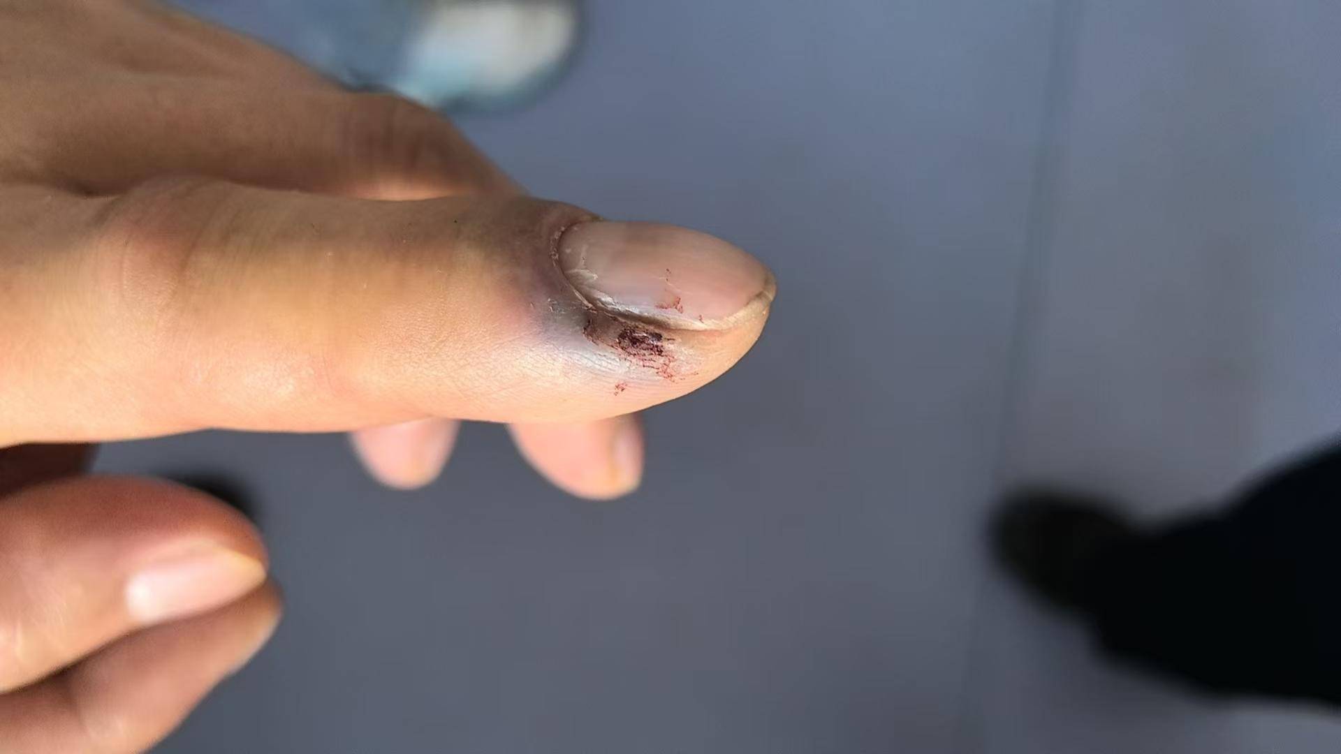 皇冠登一登二登三区别_青海一男子被罕见剧毒阿拉善蝮蛇咬伤皇冠登一登二登三区别，因无血清一度想放弃治疗 警车开道转运700公里救命