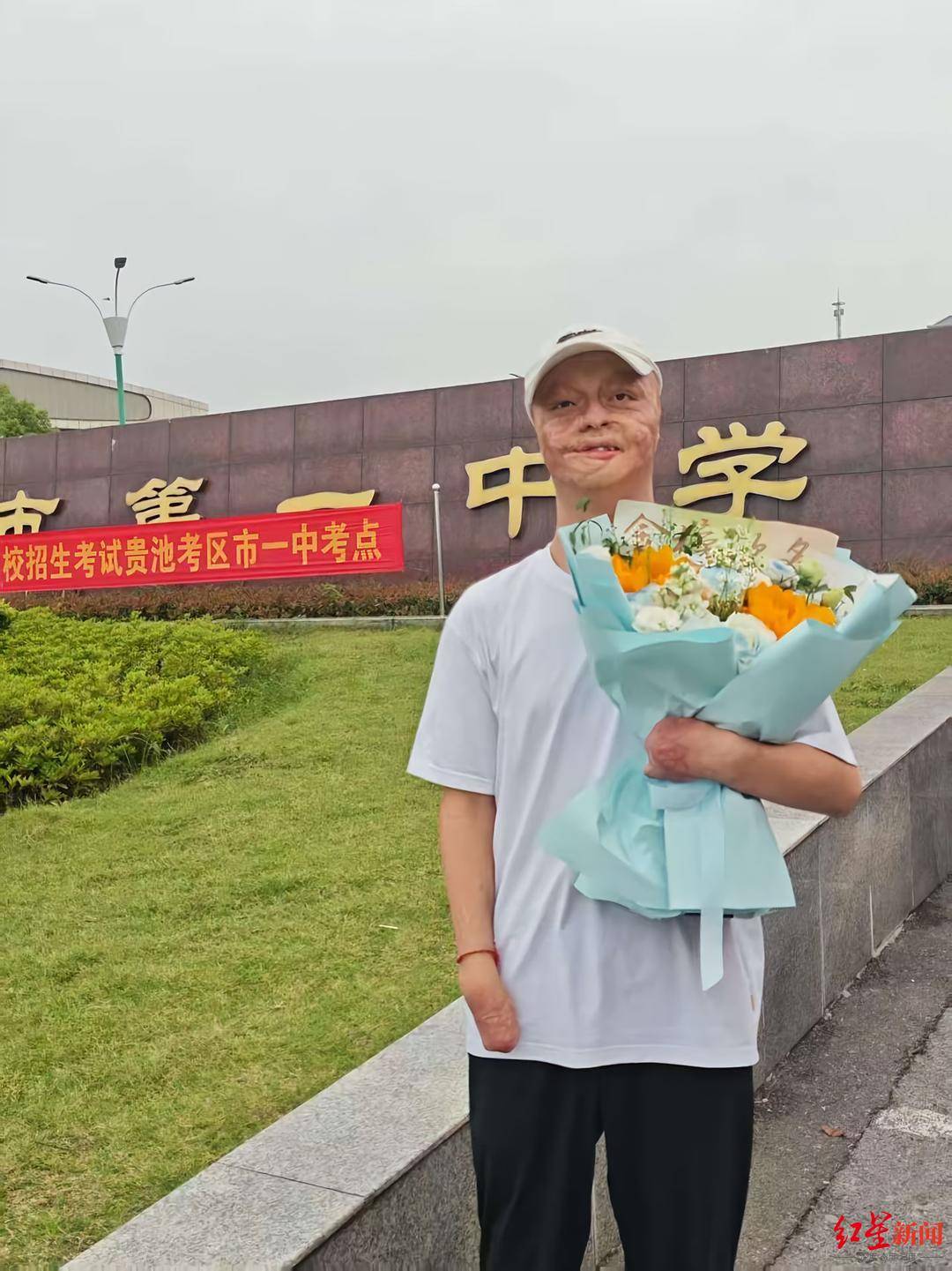 皇冠球網怎么做代理_“烧伤男孩”高考664分被东南大学录取：曾经历23次手术皇冠球網怎么做代理，计划未来读研读博