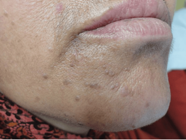 皇冠信用盘网址_脖子上长出的小肉粒皇冠信用盘网址，能揪吗？