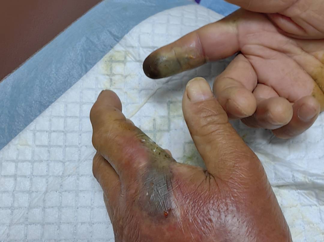 奥胡斯vs弗雷德里西亚_眼镜王蛇咬伤老人奥胡斯vs弗雷德里西亚，家属拖两米多长的“凶手”冲进医院！“拎蛇就医”可取吗？