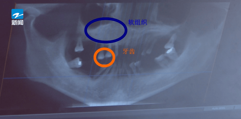 皇冠体育App下载_44岁女子牙齿掉光皇冠体育App下载！只因这个很多人都忽视的“小问题”……