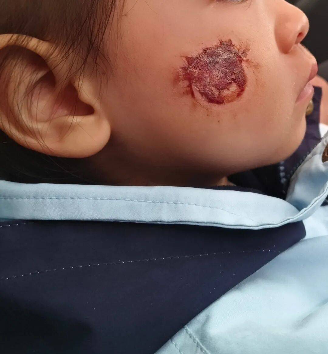 皇冠客服_3岁女童脸部糜烂皇冠客服，这东西很多人都在玩！紧急提醒