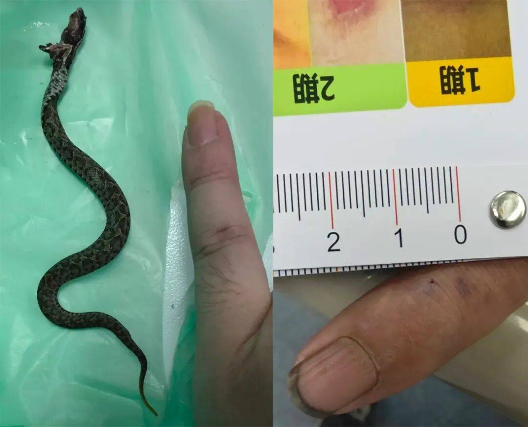 意大利甲组联赛
_男子晚上抓黄鳝意大利甲组联赛
,摸上来一条毒蛇:狠狠咬住手不放,医生:秋季蛇类活动依旧十分频繁,不要掉以轻心